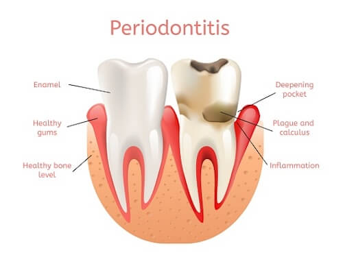 periodontal therapy