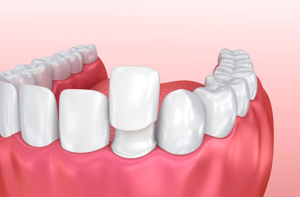 dental veneers